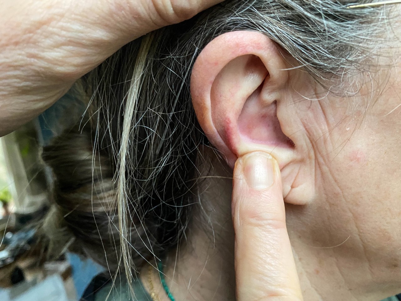 Pimple in ear causes and how to get rid of them Miracle Ear